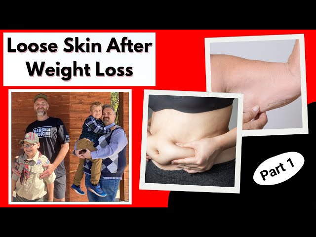 Loose Skin After Weight Loss: What You Need to Know